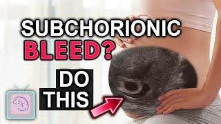 Subchorionic hemorrhage in pregnancy. Everything to know