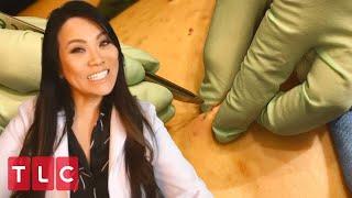 Popping Hair Cysts From a Patient's Abdomen! | Dr. Pimple Popper: This is Zit