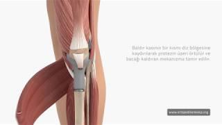 Proksimal Tibia Protez Uygulaması