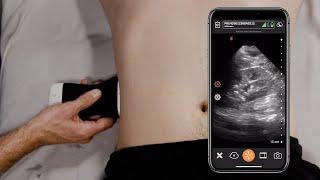 POCUS of the Kidneys
