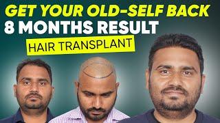 Hair Transplant in Chennai | Best Results & Cost of Hair Transplant in Chennai