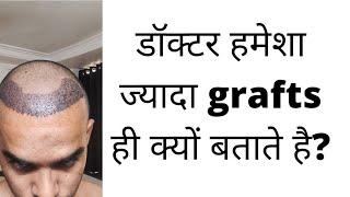 Over-quoting of grafts in hair transplant.hair transplant मे ज्यादा grafts बताए जाने की समस्या।