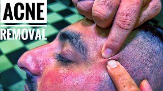 ASMR ACNE REMOVAL AND ASMR MASSAGE • Cleanliness and comfortable sleep • Sivilce Temizleme