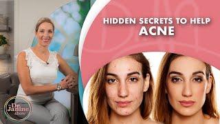 Hidden Secrets to Get Rid of Acne Naturally : Episode 13 – DrJ9 live