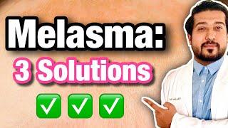 Melasma Treatment on ANY SKIN | How to Get Rid of Melasma Quick