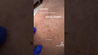 Skin How To?  Basal cell carcinoma, an example.  @drangelabrimhall @theholisticderm