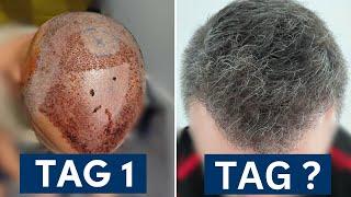 Heilungsphase nach Haartransplantation: Schneller als gedacht!