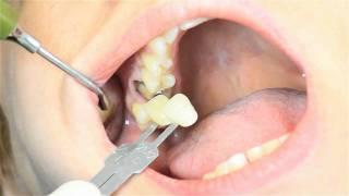 Prótese Fixa: Confecção de coroa total em cerâmica (sistema Cerec CAD/CAM)