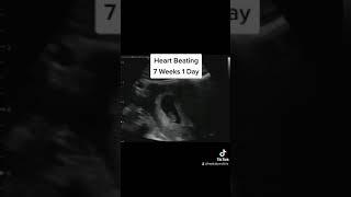 Baby's Heart Beating at 7 Weeks 1 Day Pregnant on Ultrasound