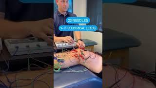 Dry Needling Study for Knee Osteoarthritis