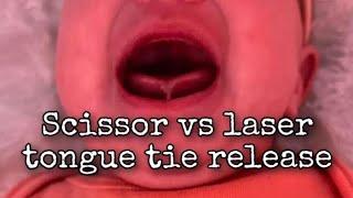 Is scissors or laser better for a tongue tie release?