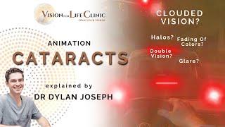 How Do Cataracts Affect Your Vision? | Animation explained by Dr Dylan Joseph