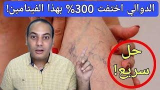 تناوله يوميا لعلاج دوالي الساقين نهائياً بنسبة 300 %/علاج الدوالي بدون جراحه / افضل فيتامين للدوالي!