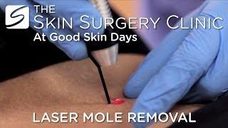 Laser Mole Removal | Watch the Procedure