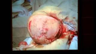 Neurosurgery treatment of extensive defects of skull