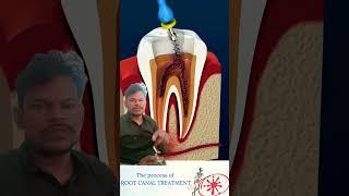 Root canal treatment processing step by step k p techblock ll #rootcanaltreatment #rootcanal