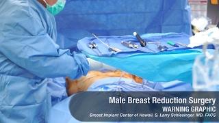 Male Breast Reduction (Man Boob) Surgery Video - GRAPHIC. Award-Winning Plastic Surgeon