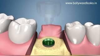 Dental Implants (Step by Step Procedure)