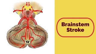 Brainstem Stroke Syndromes