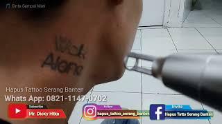 Hapus tatto di leher