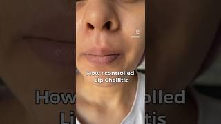 Lip Cheilitis - Lip disease that looks like very dry chapped lips but ITS NOT! #cheilitis