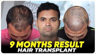 Hair Transplant in Chennai | Best Results & Cost of Hair Transplant in Chennai