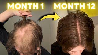 FINASTERIDE Stopped My Hair Loss in 1 YEAR! | AL GARRIDO