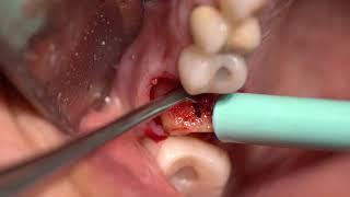 Ext, Implant and Bone Graft with Complication