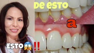 limpieza dental profunda en Estados Unidos/periodontitis