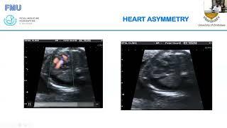 Fetal Echocardiography (The Basics) - Dr Verenga