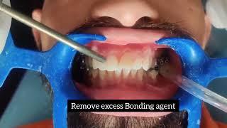 Orthodontic Bonding Procedure