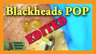 Blackheads POP! EDITED | Auburn Medical Group