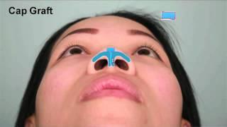Asian Rhinoplasty Tip Augmentation Case Study Part 2 |  Dr. Thomas Buonassisi, 8 West Clinic in BC