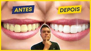 O que NÃO TE CONTAM sobre Clareamento Dentário...