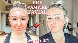 $1,000 Vampire Facial Experience (PRP with Microneedling)