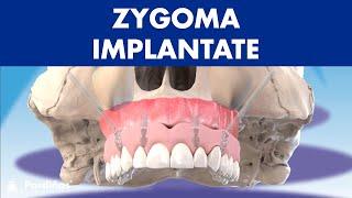 ZYGOMA-Implantate - Behandlung ohne Knochenaufbau ©