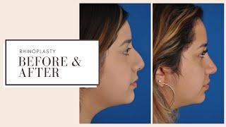 Plastic Surgery Before & After | Rhinoplasty (Nose Job) | ESKMD NYC