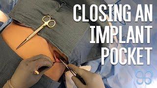 Breast Augmentation Surgery: Plastic Surgeon Closing an Implant Pocket | Brown Plastic Surgery