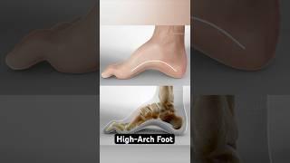 The shape of your foot could be causing your pain (3D Animation)
