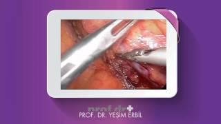Sol adrenal kitlelerde renal ve adrenal ven