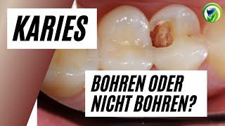 Karies - Zahn bohren oder nicht bohren? - Abwarten und beobachten? Das ist hier die Frage!!!