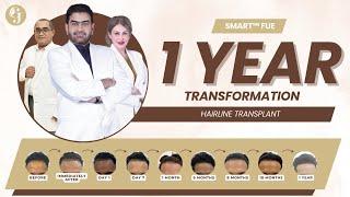 1-Year Transformation With SMART™ FUE Hairline Transplant  GLOJAS AESTHETIC CLINIC |