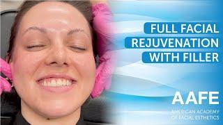 Full Facial Rejuvenation with Filler