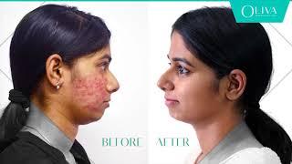 How To Remove Pimples - Professional Treatments For Acne