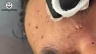 PIMPLE POPPING & BLACK HEAD REMOVAL 