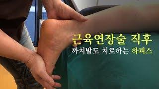 까치발근육연장술 직후 모습