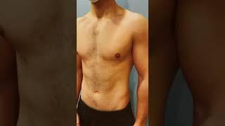 Gynecomastia Gland Removal Surgery 24 year Old Male from VIRGINIA 