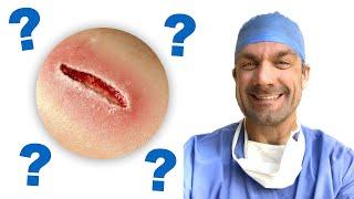 Surgical Wound Infection - Prevention Strategies!