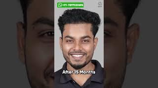 Fifteen Months Hair Transplant Results | Latest Fue Technique #shorts #viralvideo  #hair transplant