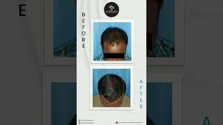Best Hair Transplant Results | Dr. Rashmi Aderao Skin, Hair & Laser Clinic Pune